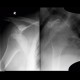 Hill-Sachs sign, dislocation of glenohumeral joint: X-ray - Plain radiograph
